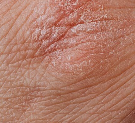 Dry flaky skin in cats early signs and possible reasons