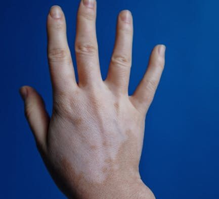 Dog skin pigmentation changes dark patches early signs