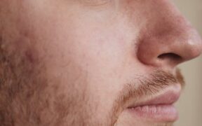 Cat chin acne blackheads symptoms and monitoring