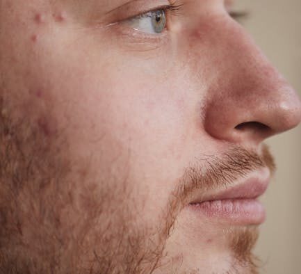 Cat chin acne blackheads symptoms and monitoring