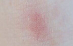 Dog skin redness around belly symptoms and when to see a vet