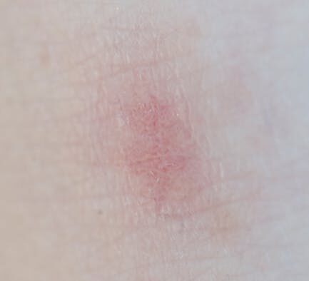 Dog skin redness around belly symptoms and when to see a vet