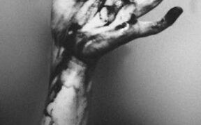 When unexplained bruising needs evaluation