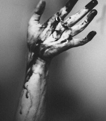 When unexplained bruising needs evaluation