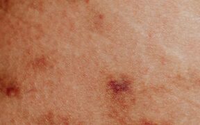 Can my dog have skin inflammation after medication