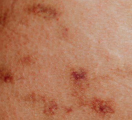 Can my cat have skin inflammation from parasites