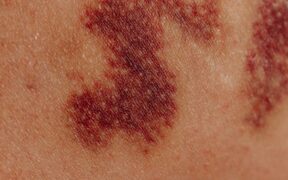 Pain related to inflammation in pets