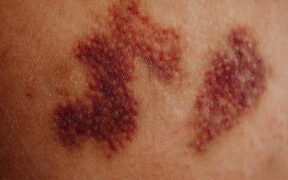 Can my dog have skin discoloration after wounds