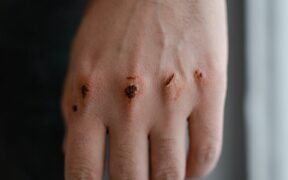 Can my cat have skin infections without wounds